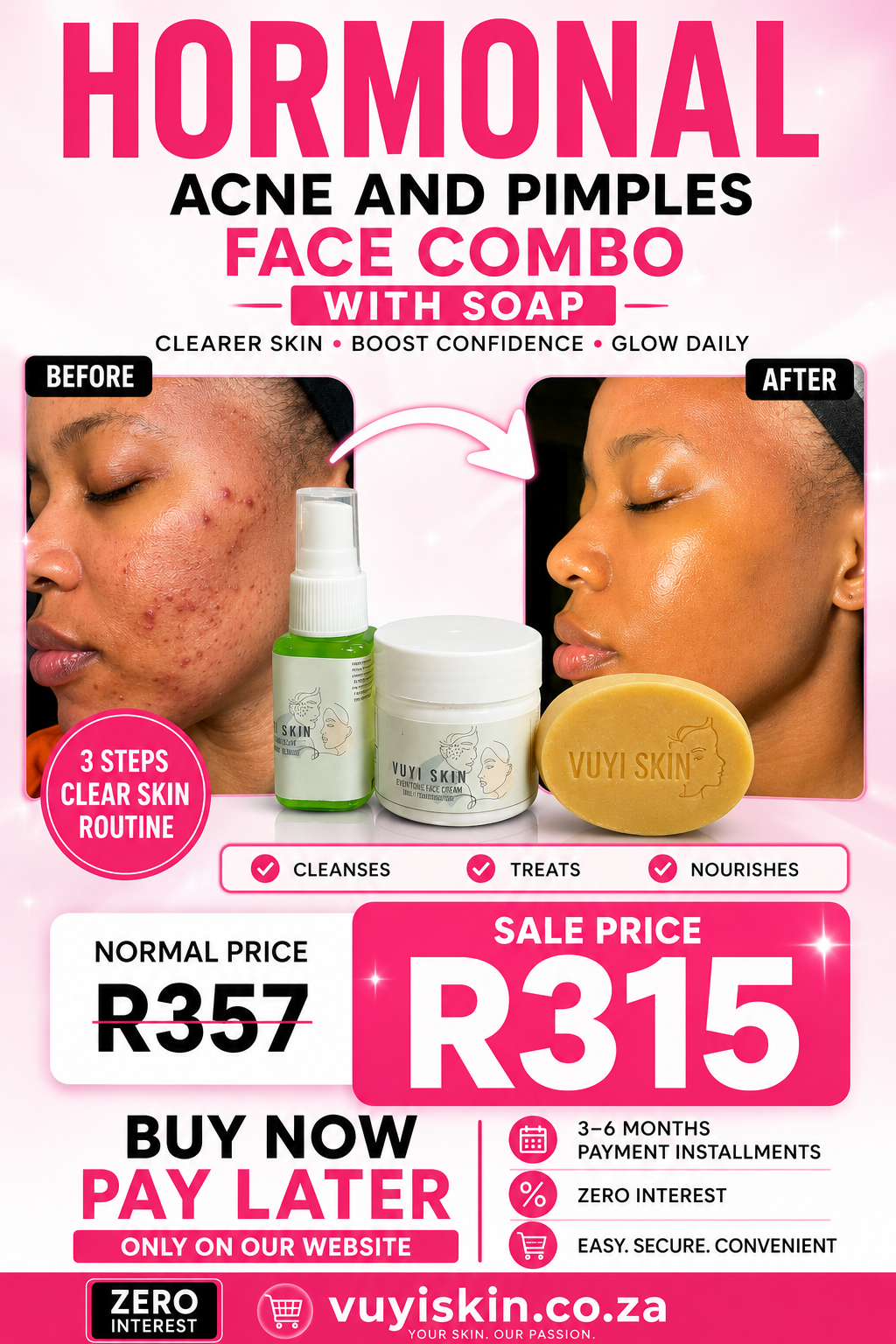 Hormonal Acne and Pimples Face Combo with Soap - Before and After