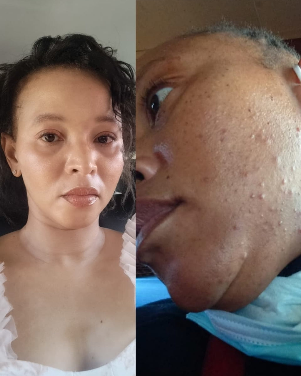 Hormonal Acne Treatment Combo