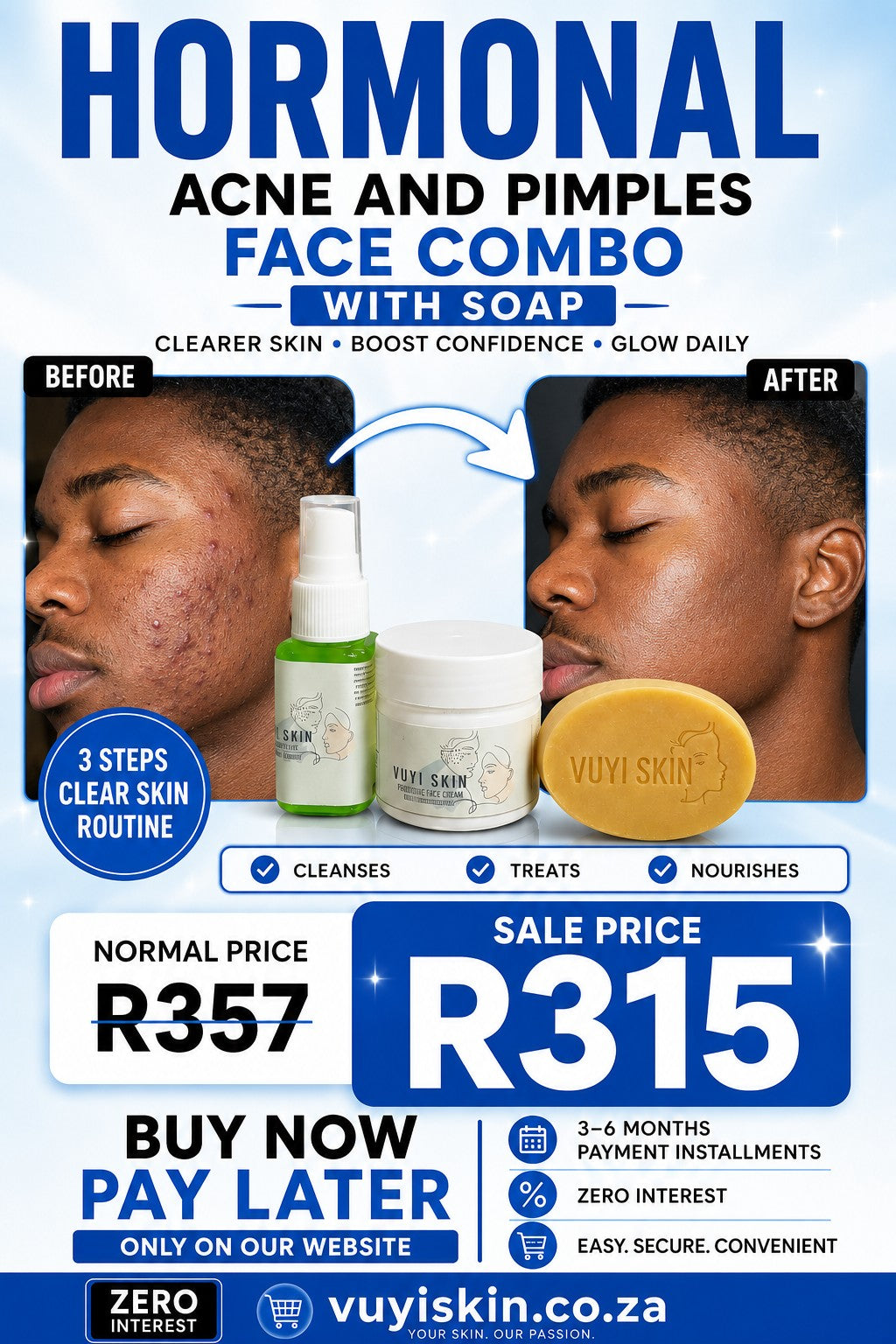 Hormonal Acne and Pimples Face Combo with Soap - Before and After results